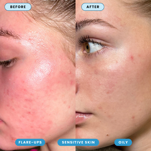 Hypochlorous Acid Spray - Cleanse & Soothe