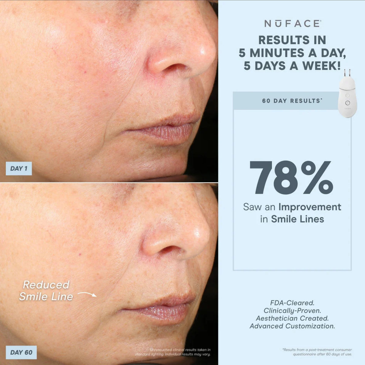 NuFACE Trinity+ Pro ELE Attachment