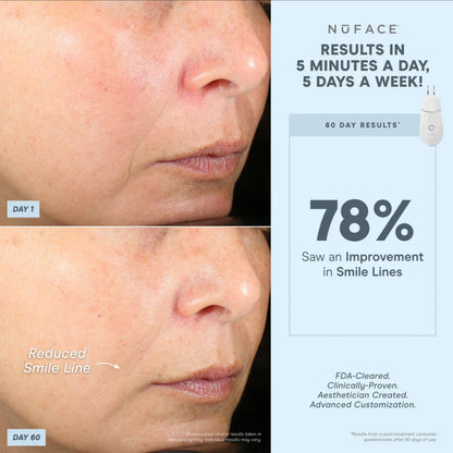 NuFACE Trinity+ Pro ELE Attachment