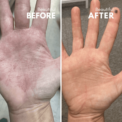 Trivolos | Eczema Cream